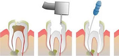 Tratamento conhecido como canal, que elimina bactérias que atingem a polpa dentária.